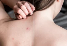 How to Treat and Prevent Body Acne with the Right Products Body Acne